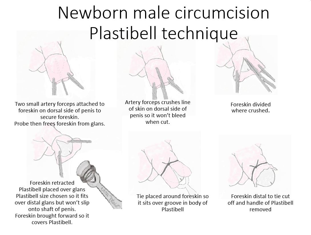 Circumcision And Your Newborn Baby Obstetric Excellence