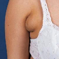 Armpit Lumps During Pregnancy