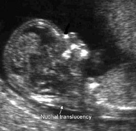 Nuchal Translucency (NTS) in Pregnancy | Obstetric