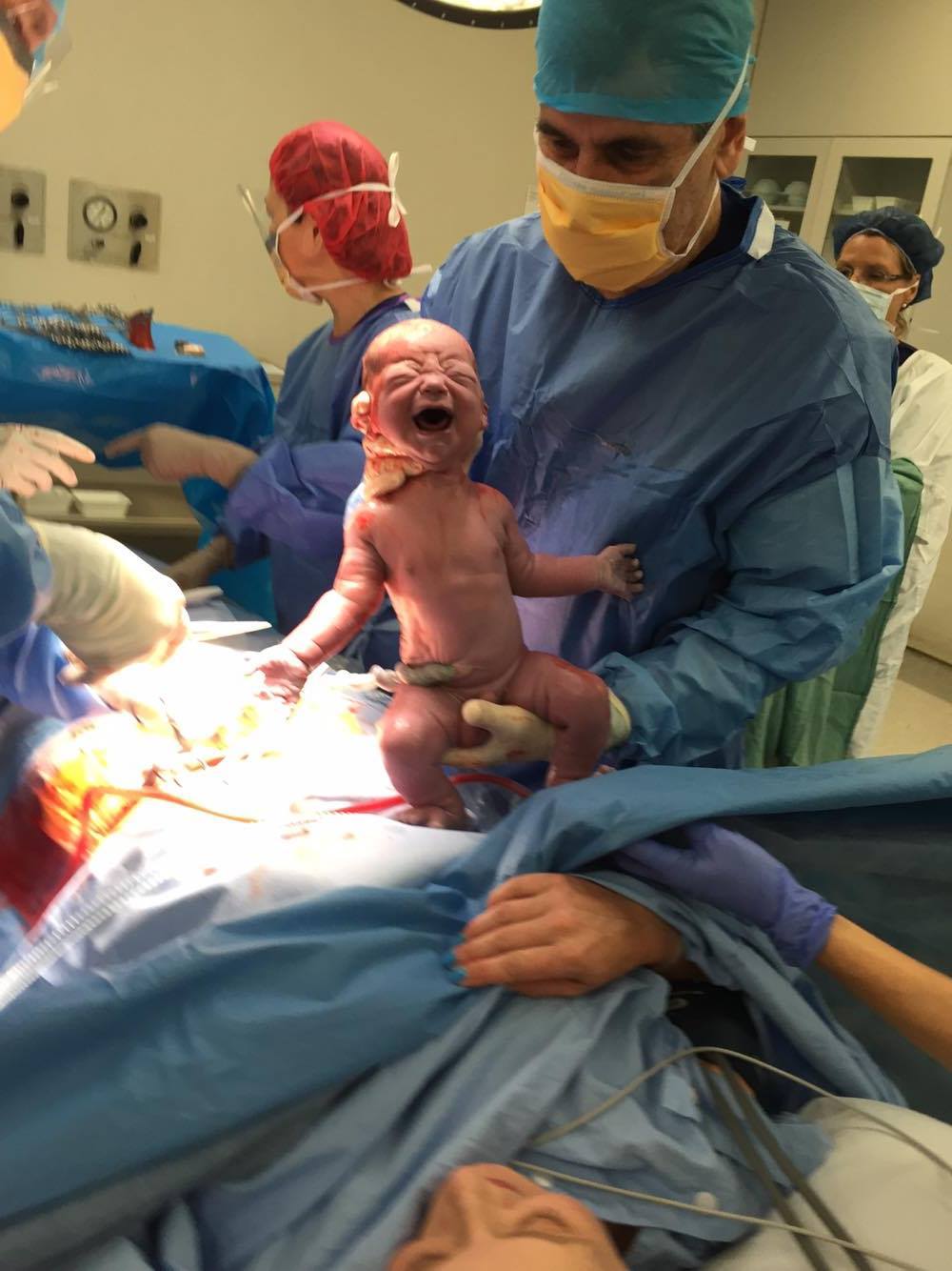 Delayed Cord Clamping for C-Sections