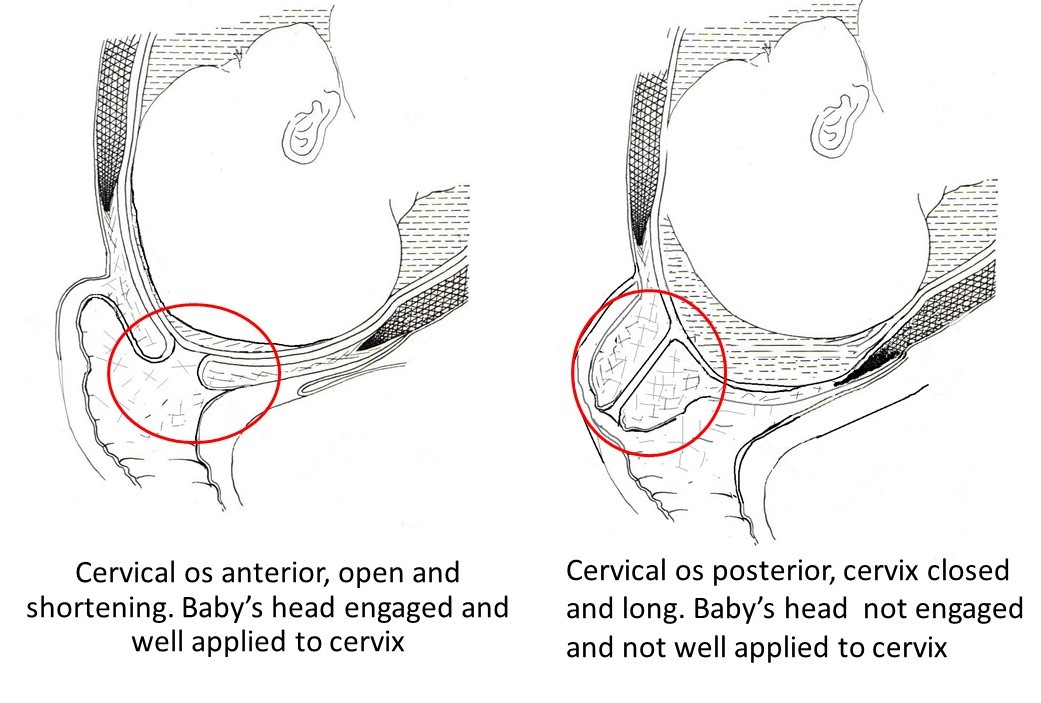 Cervical Os Open Vs Closed HarrymcyWise