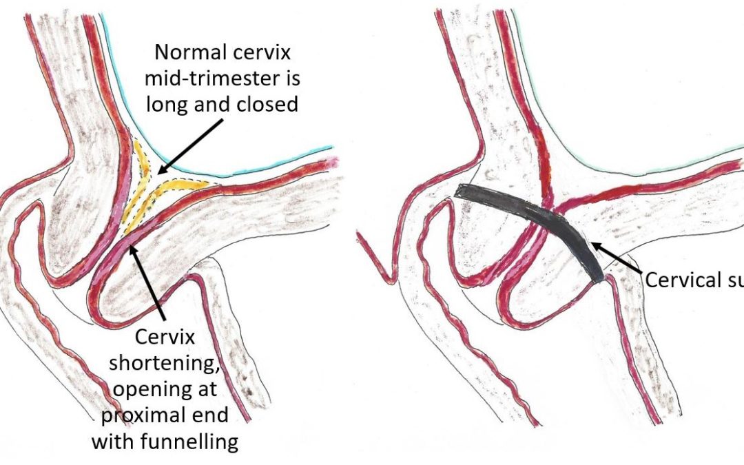 Short Cervix During Pregnancy  Short Cervix Treatment - The Pulse