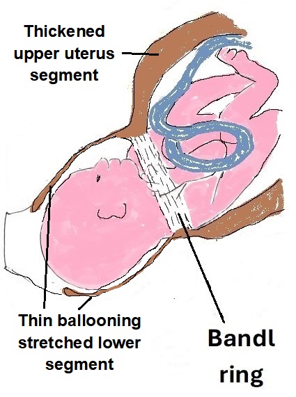 A tragic labour and childbirth outcome that was potentially avoidable.